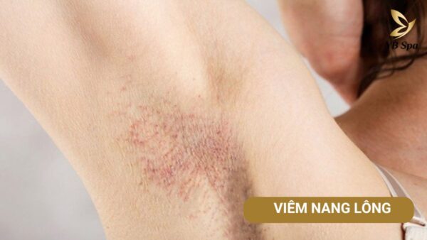 Vì sao triệt lông thường bị viêm nang lông? 20 Viem Nang Long (2)