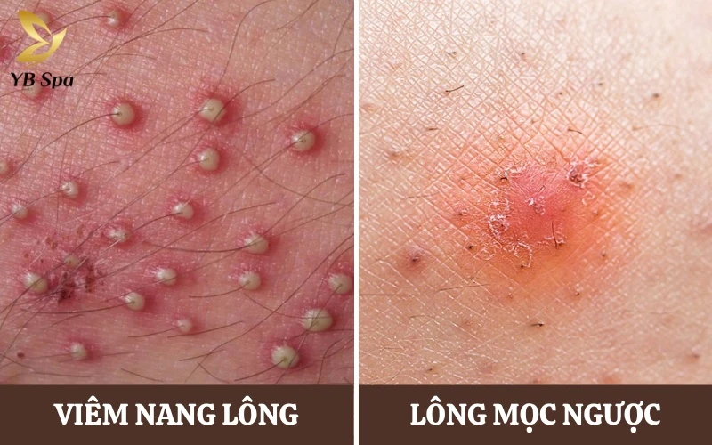 Những nốt mụn đỏ, sưng tấy do viêm nang lông và lông mọc ngược là rủi ro thường gặp nếu bề mặt da không được làm sạch sâu trước và sau khi wax