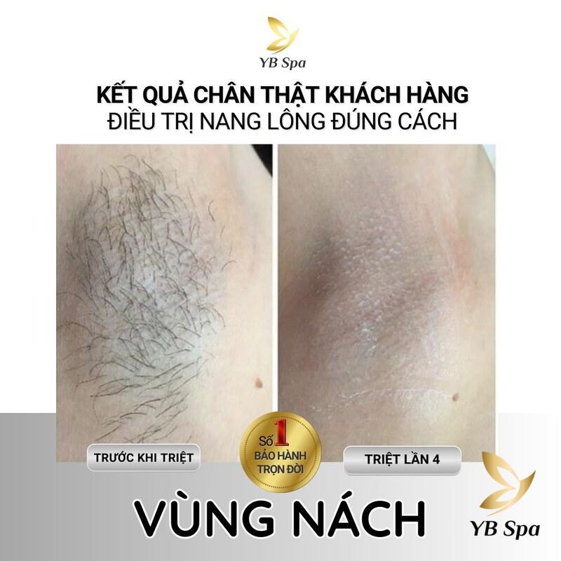 Công nghệ SHR ICE2 giúp triệt lông tận gốc không đau, không xâm lấn (Nguồn: YB Spa)