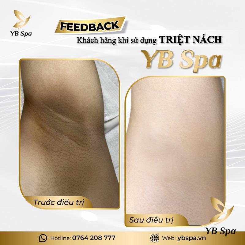 YB Spa - Triệt Lông Hiệu Quả Số 1 Sài Gòn (Nguồn: YB Spa)