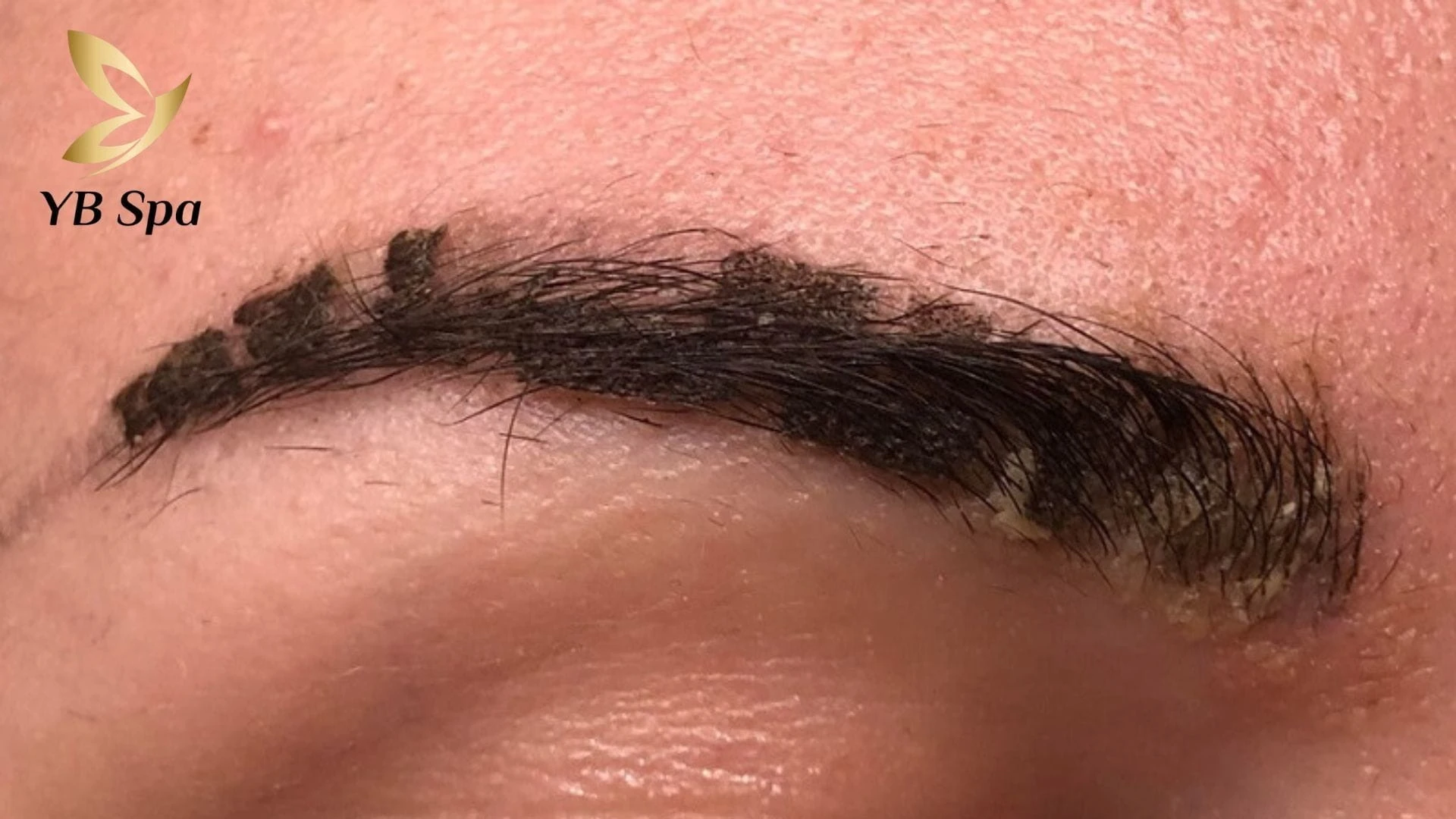 Tuyệt đối không tự ý cạy, bóc vảy khi lông mày có dấu hiệu bong tróc mà phải để vảy rụng một cách tự nhiên.