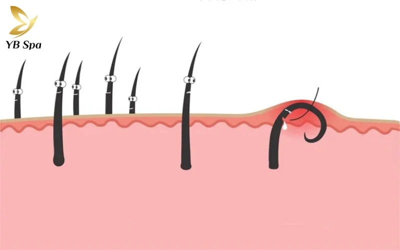 Hiện tượng lông mọc ngược thường xuất phát từ việc hướng mọc bị xáo trộn, khiến sợi lông bị mắc kẹt và gây viêm nhiễm