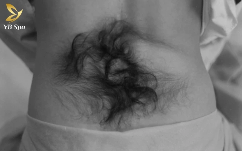 Faun tail nevus là hiện tượng xoáy lông mọc dày đặc và rậm rạp bất thường tại một vị trí cố định trên vùng lưng