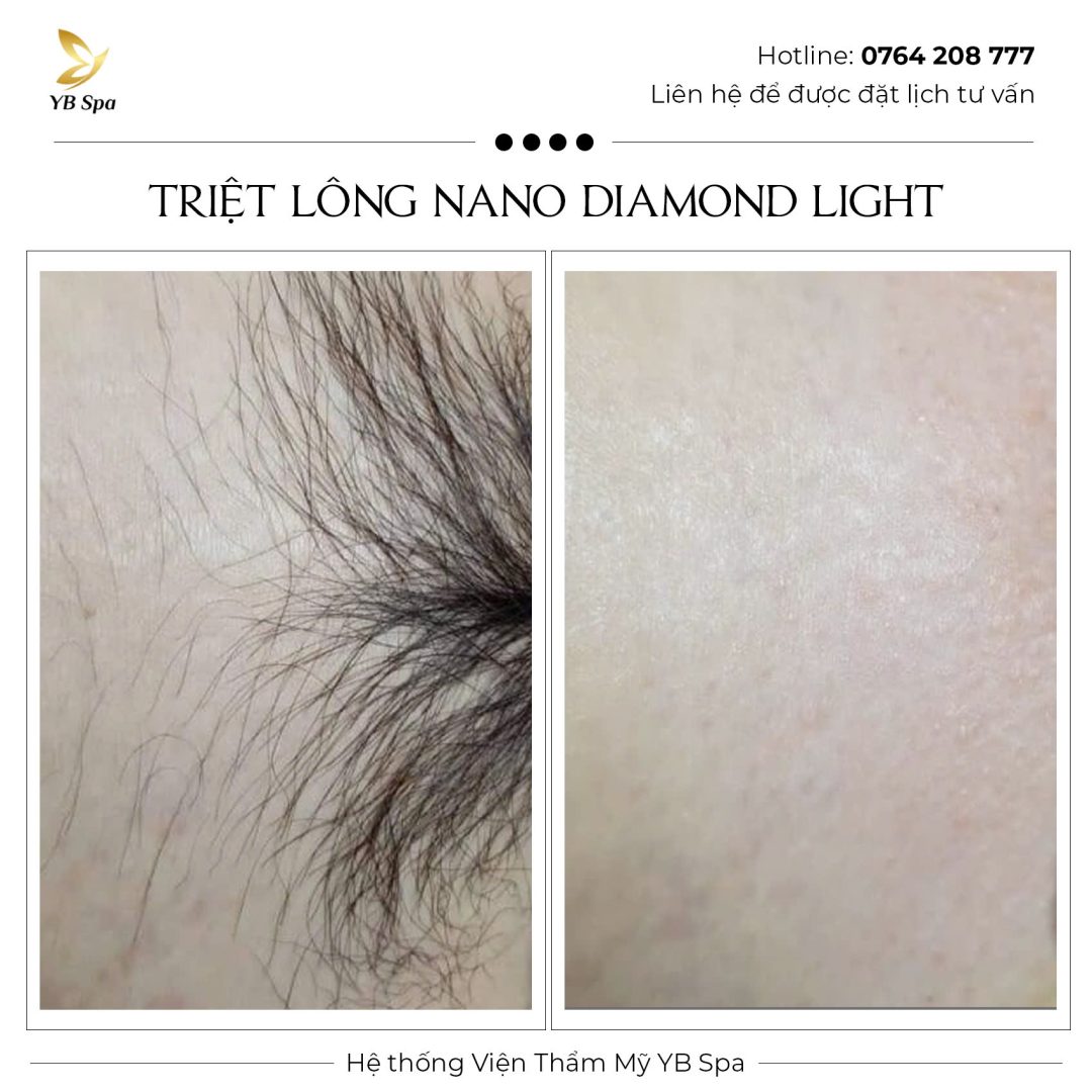 Triệt lông vĩnh viễn NANO DIAMOND LIGHT Hiệu quả 119% 39 Triệt lông vĩnh viễn NANO DIAMOND LIGHT Hiệu quả 119%