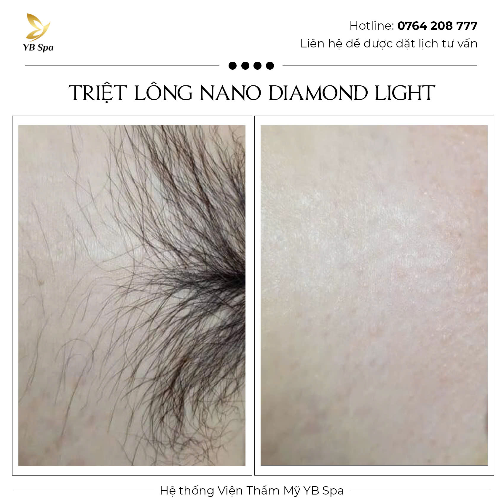 Triệt lông vĩnh viễn NANO DIAMOND LIGHT Hiệu quả 119%