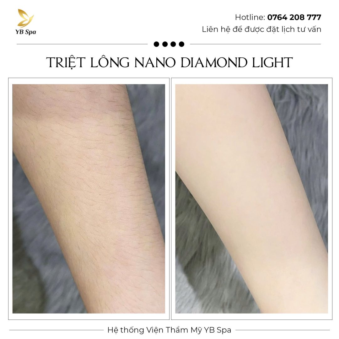 Triệt lông vĩnh viễn NANO DIAMOND LIGHT Hiệu quả 119% 37 Triệt lông vĩnh viễn NANO DIAMOND LIGHT Hiệu quả 119%