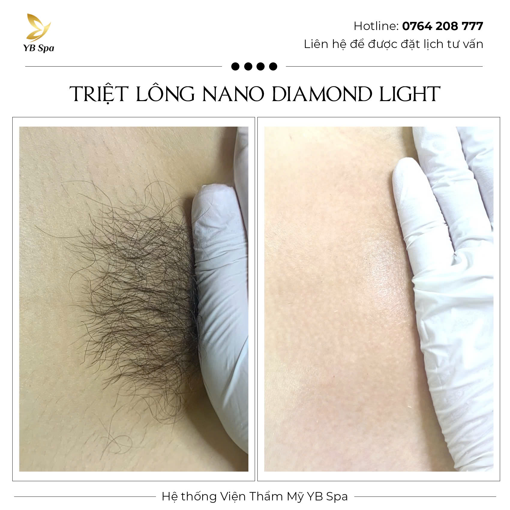 Triệt lông vĩnh viễn NANO DIAMOND LIGHT Hiệu quả 119%
