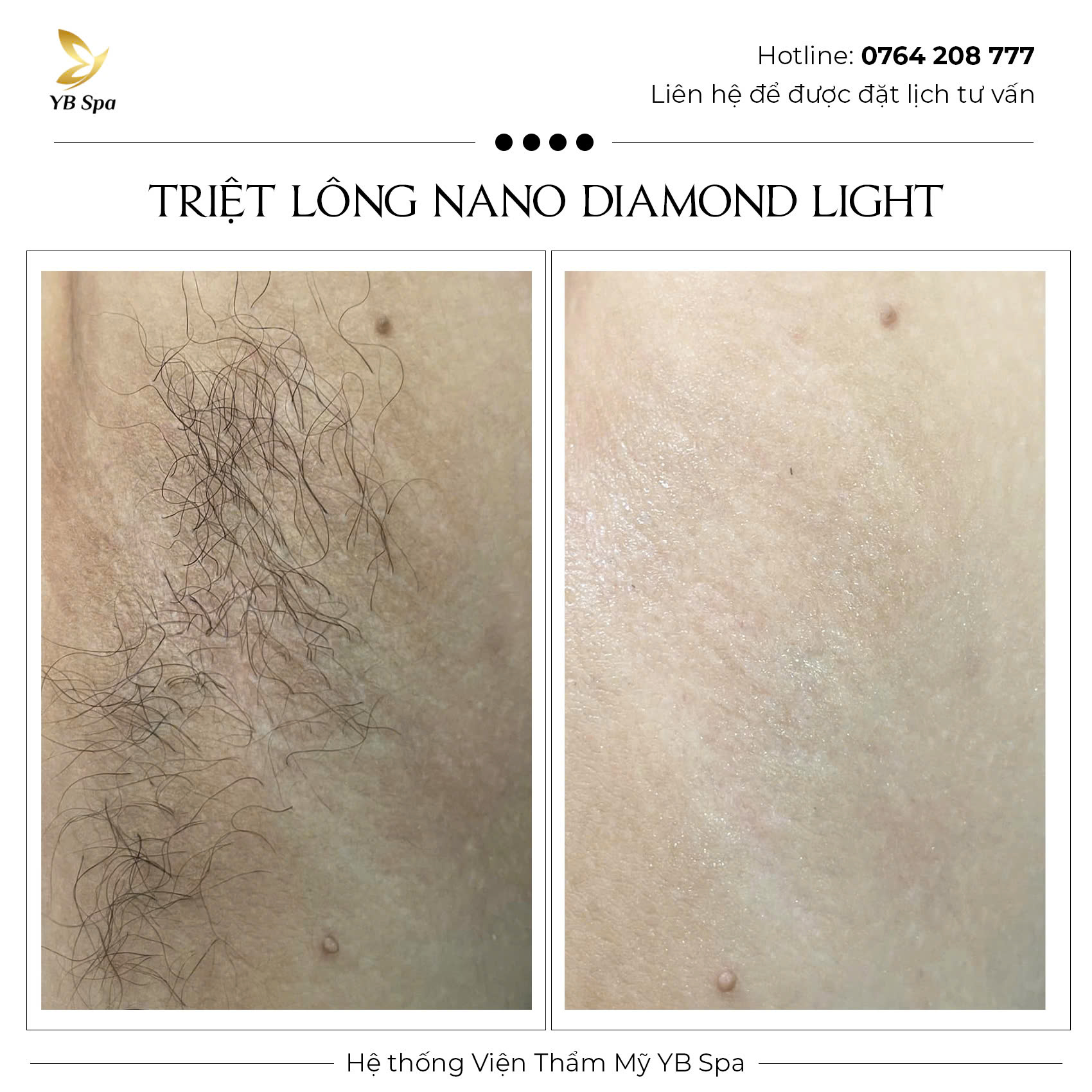 Triệt lông vĩnh viễn NANO DIAMOND LIGHT Hiệu quả 119% 36 Triệt lông vĩnh viễn NANO DIAMOND LIGHT Hiệu quả 119%
