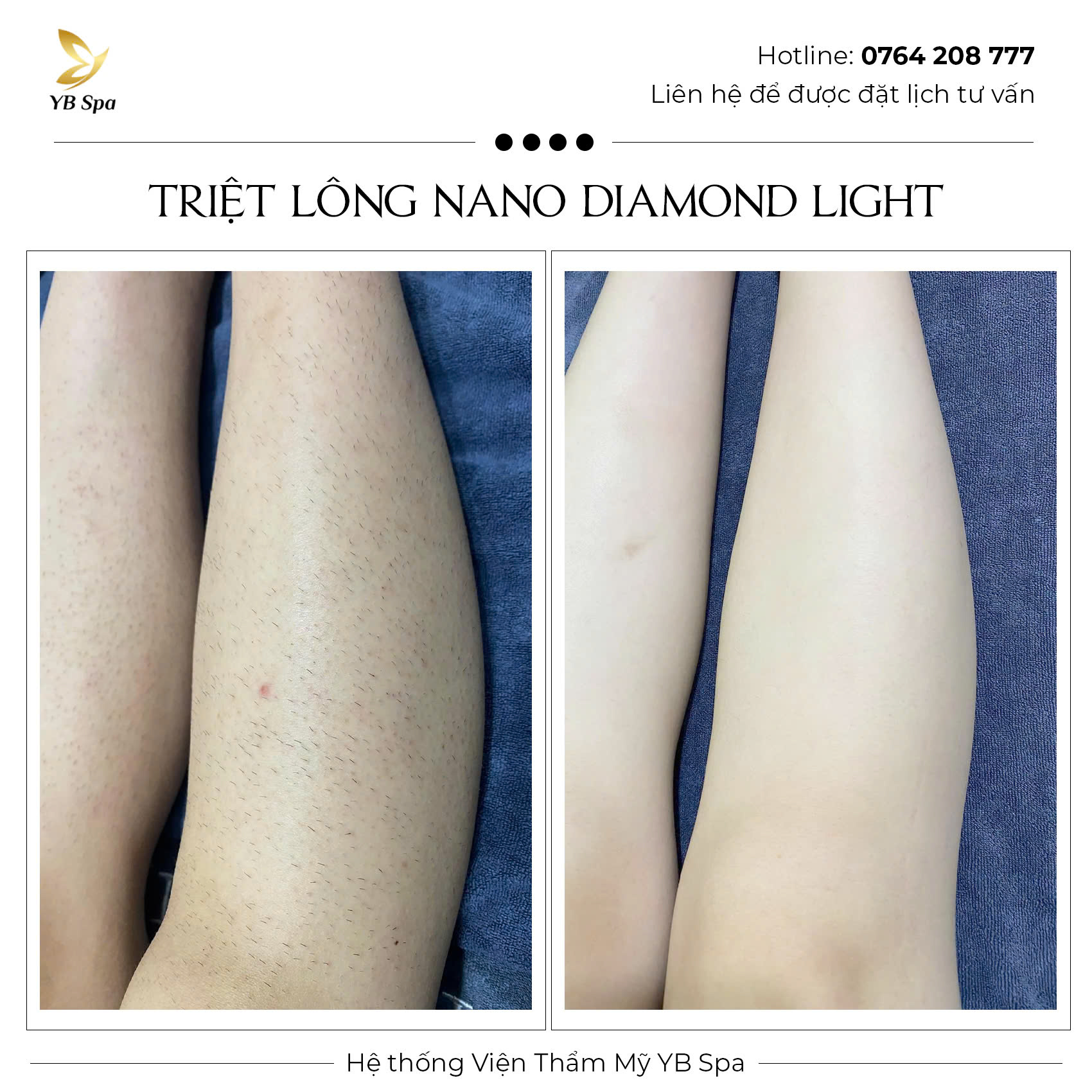 Triệt lông vĩnh viễn NANO DIAMOND LIGHT Hiệu quả 119% 35 Triệt lông vĩnh viễn NANO DIAMOND LIGHT Hiệu quả 119%