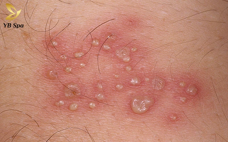 Zona có để lại sẹo không