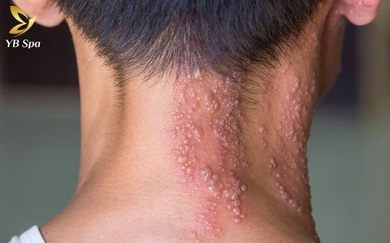 Bệnh Zona là gì?